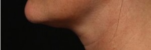 left_profile before