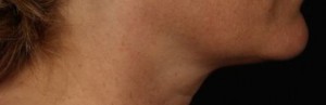 right_profile after