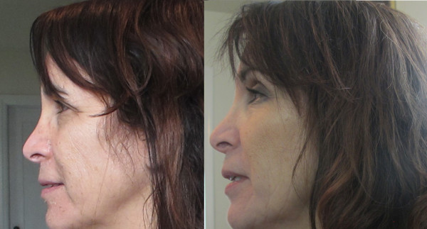 She Looked 10 Years Younger: Perfect Derma Chemical Peel